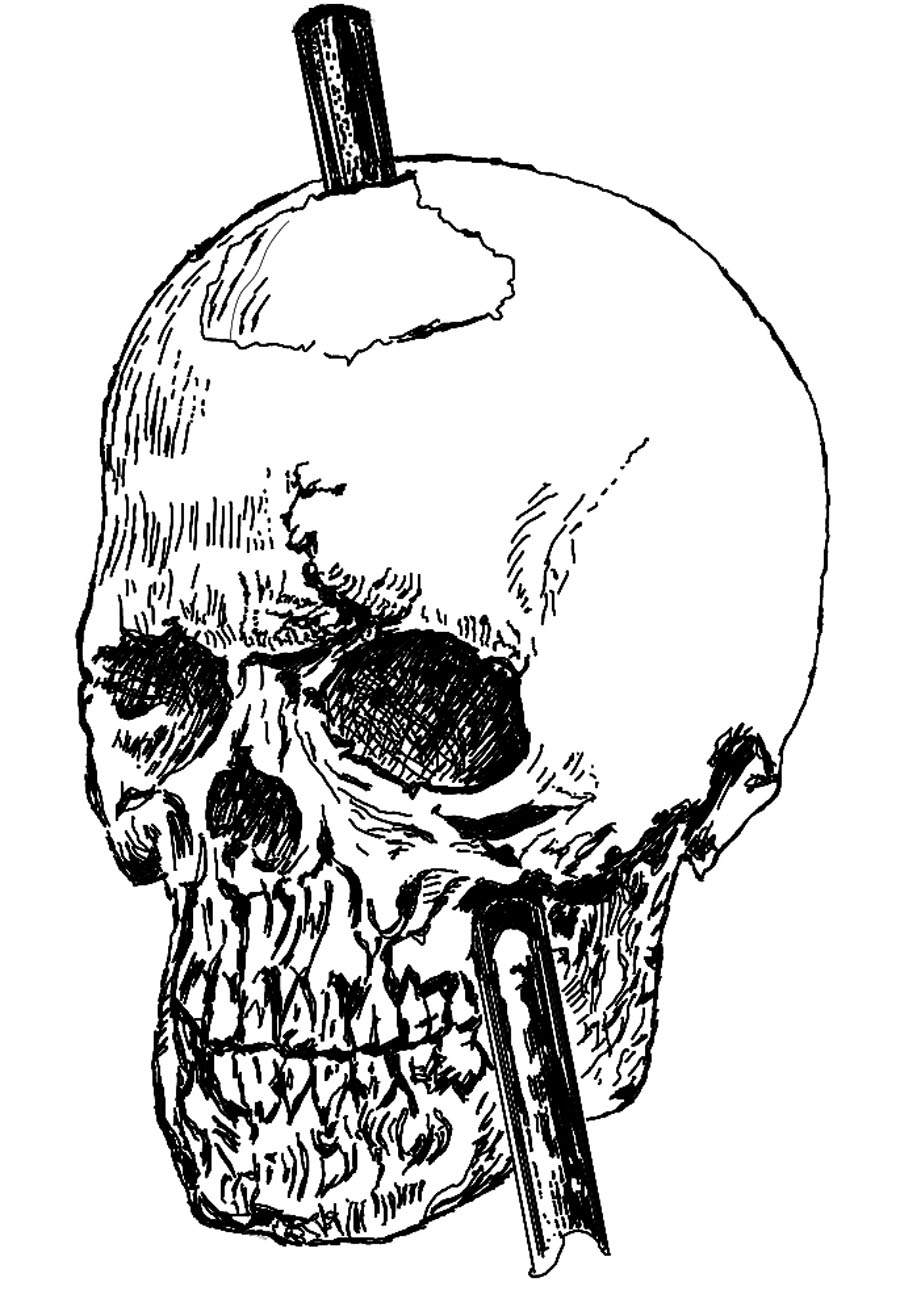the skull of Phineas Gage